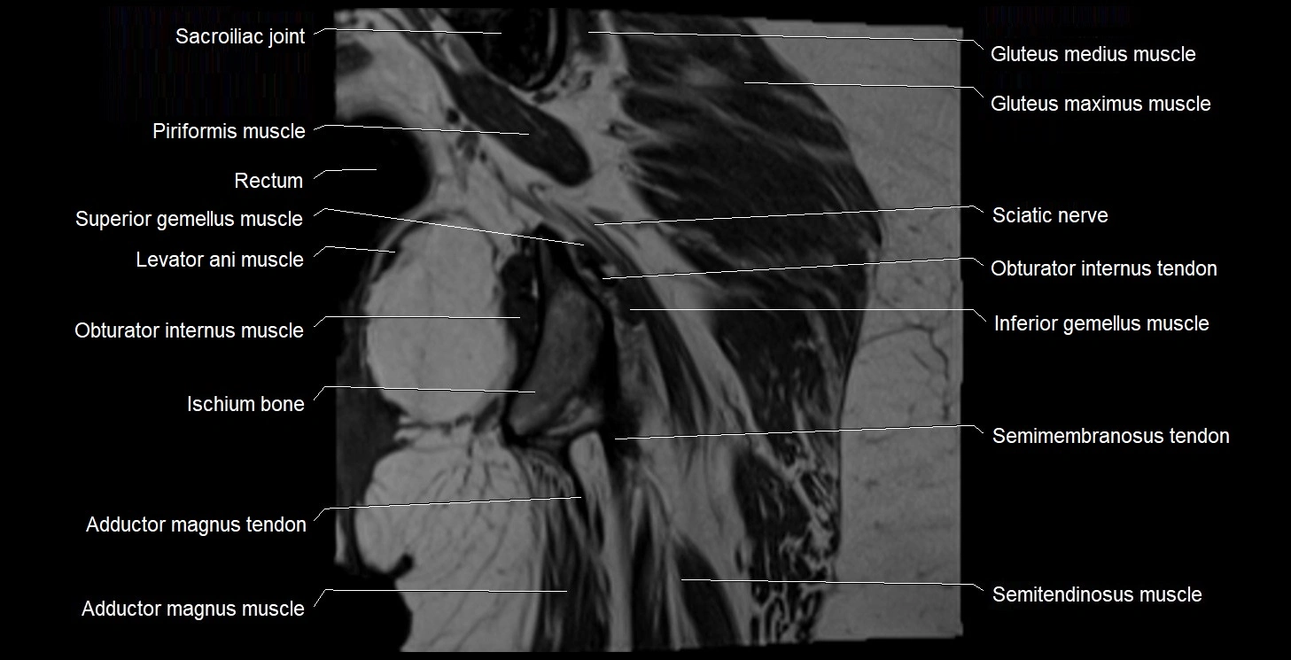 MRI Hip 3T coronal cross sectional anatomy image 50.webp